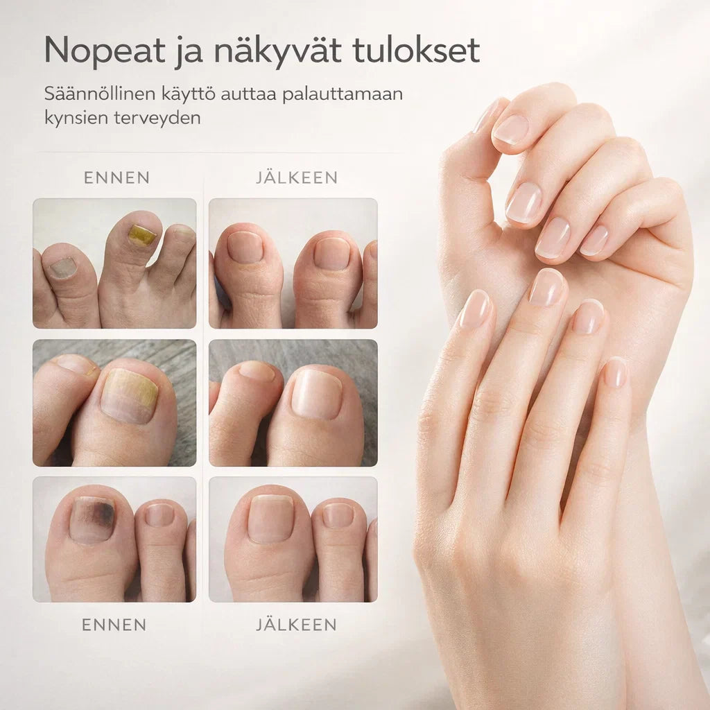 KynsiHoito – Tehokas hoito kynsisientä vastaan