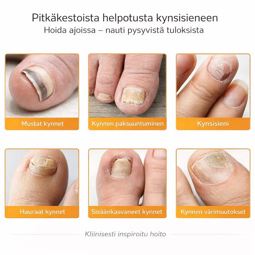 KynsiHoito – Tehokas hoito kynsisientä vastaan