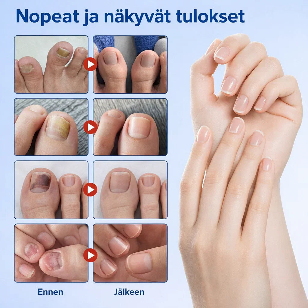 KynsiHoito – Tehokas hoito kynsisientä vastaan