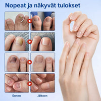 KynsiHoito – Tehokas hoito kynsisientä vastaan